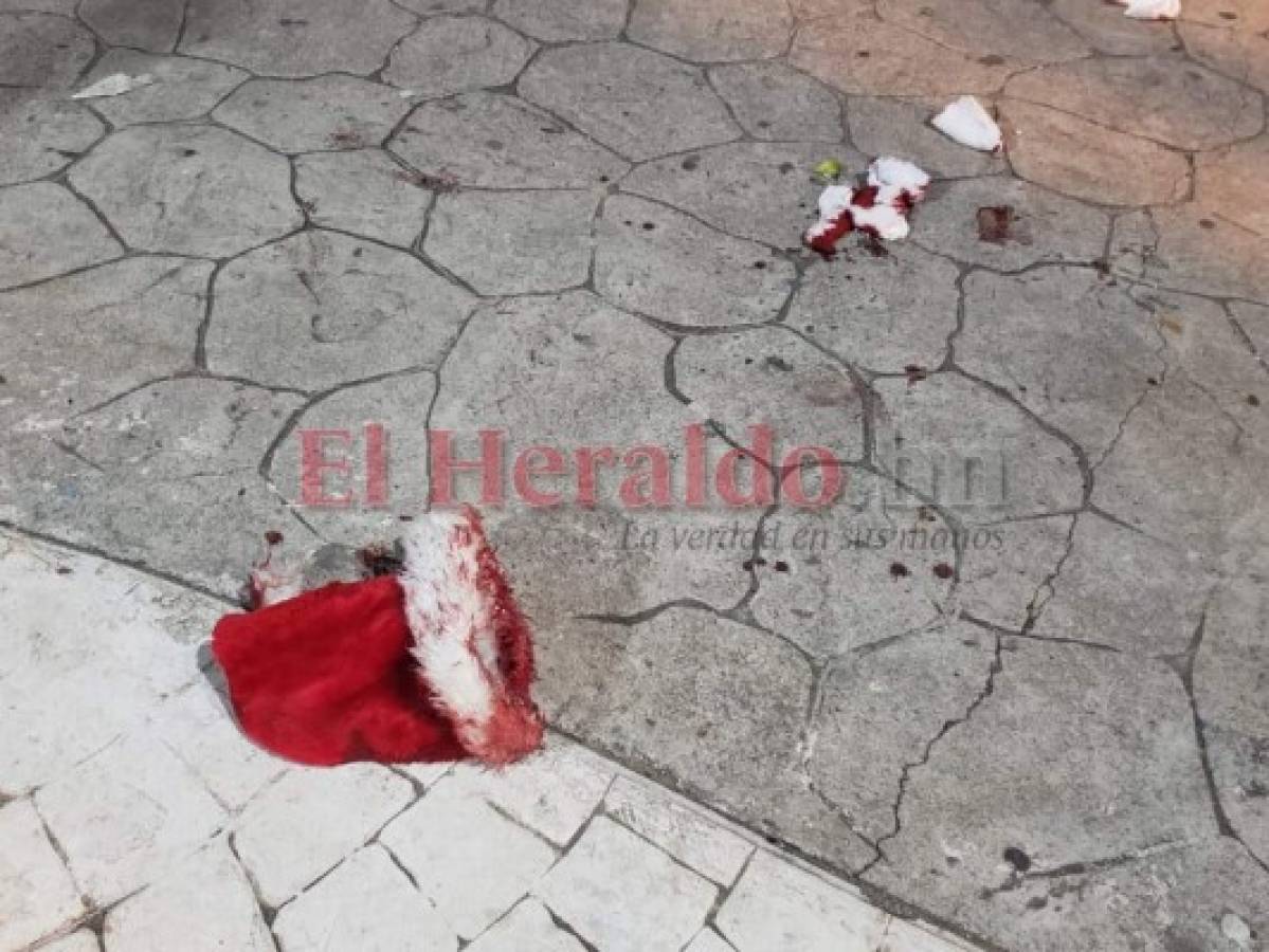 Mortero le explota en el rostro a un joven en Choluteca