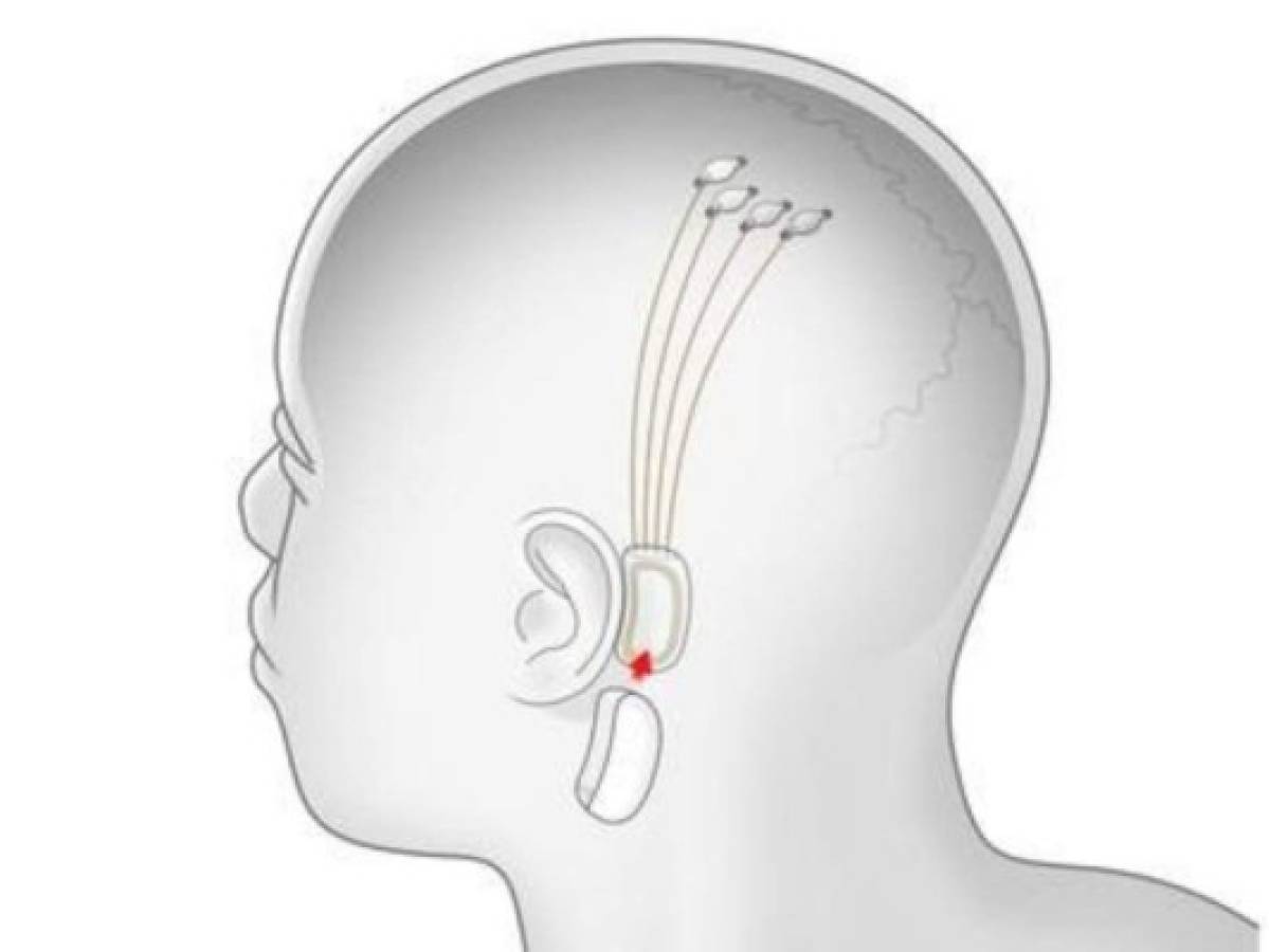 Anteriormente, el dispositivo sería implantado detrás de las orejas, pero el equipo consideró más oportuno hacerlo en la parte superior del cerebro.