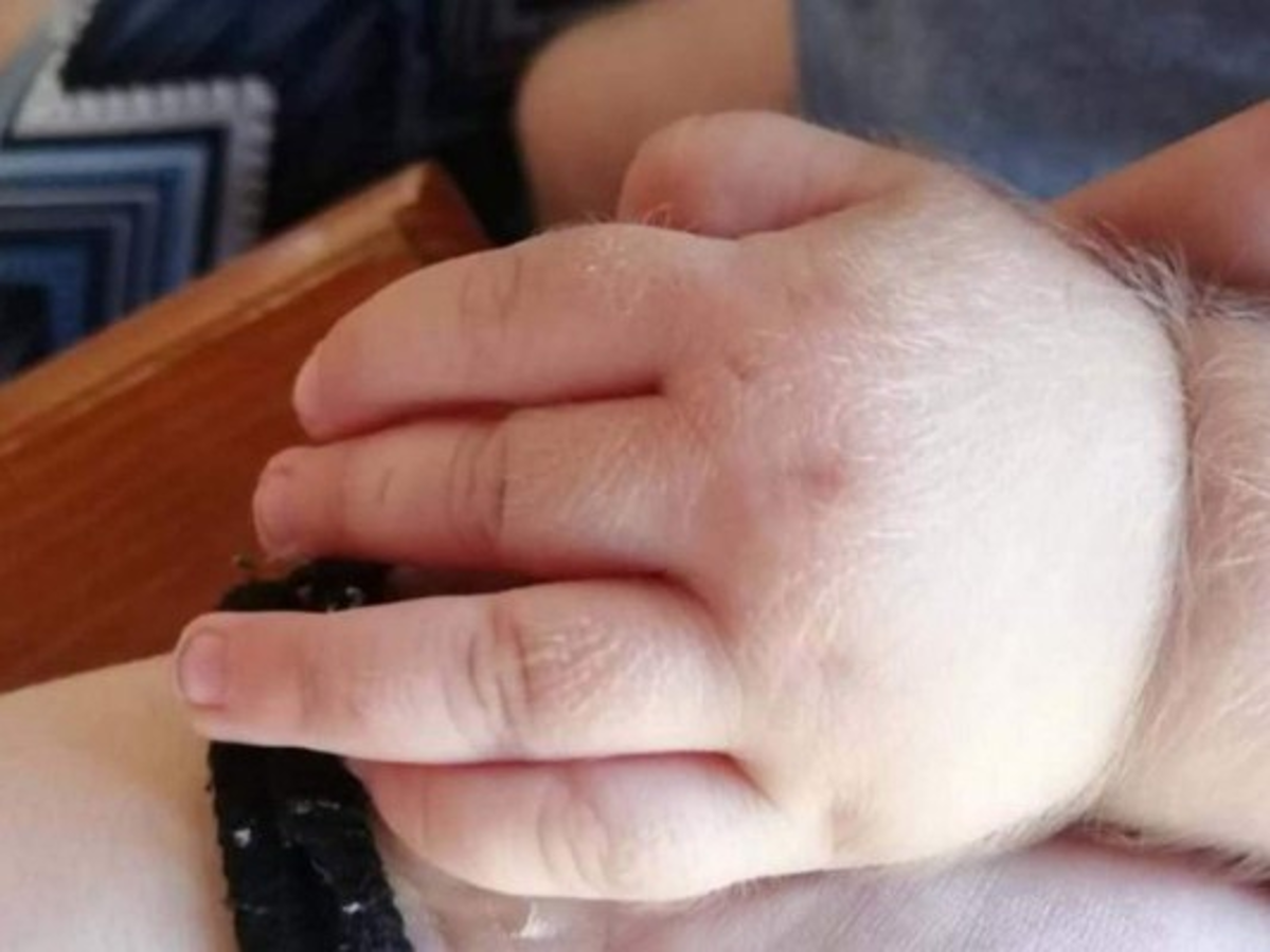 Niños españoles contraen 'síndrome del hombre lobo' por una medicina