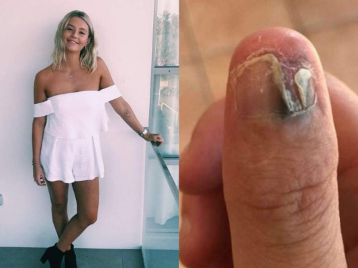 Joven sufre cáncer y amputación del pulgar por comerse las uñas