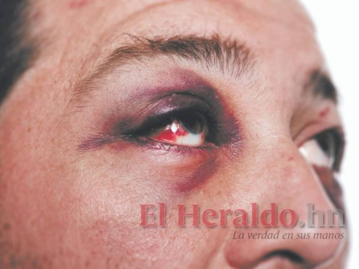 Salud adquirirá medicamentos en EEUU para pacientes con hongo negro