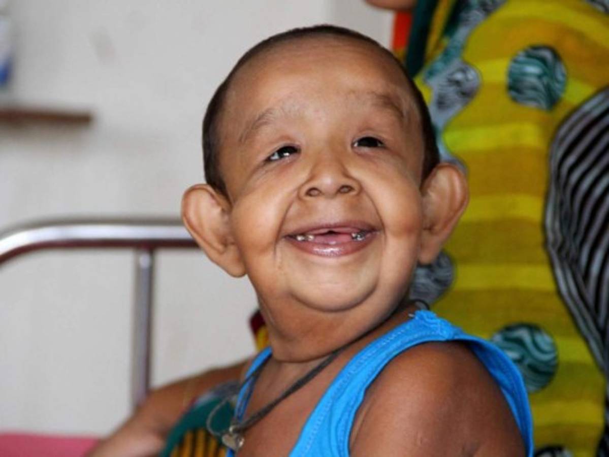 Misteriosa enfermedad hace que niño bangladesí de cuatro años parezca un anciano