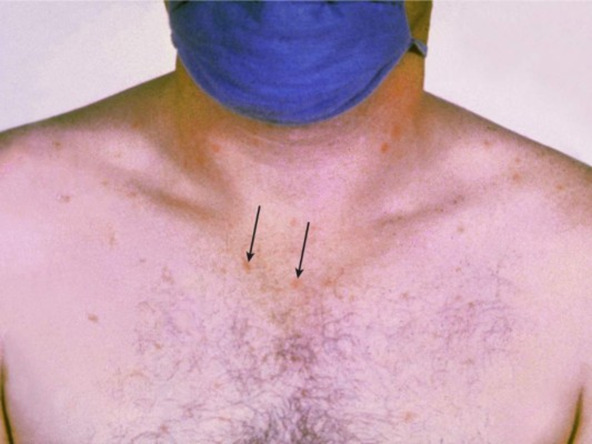 Al igual que la hepatitis, se transmite mediante el agua o alimentos que están contaminados, cuando es grave se necesita atención de emergencia.