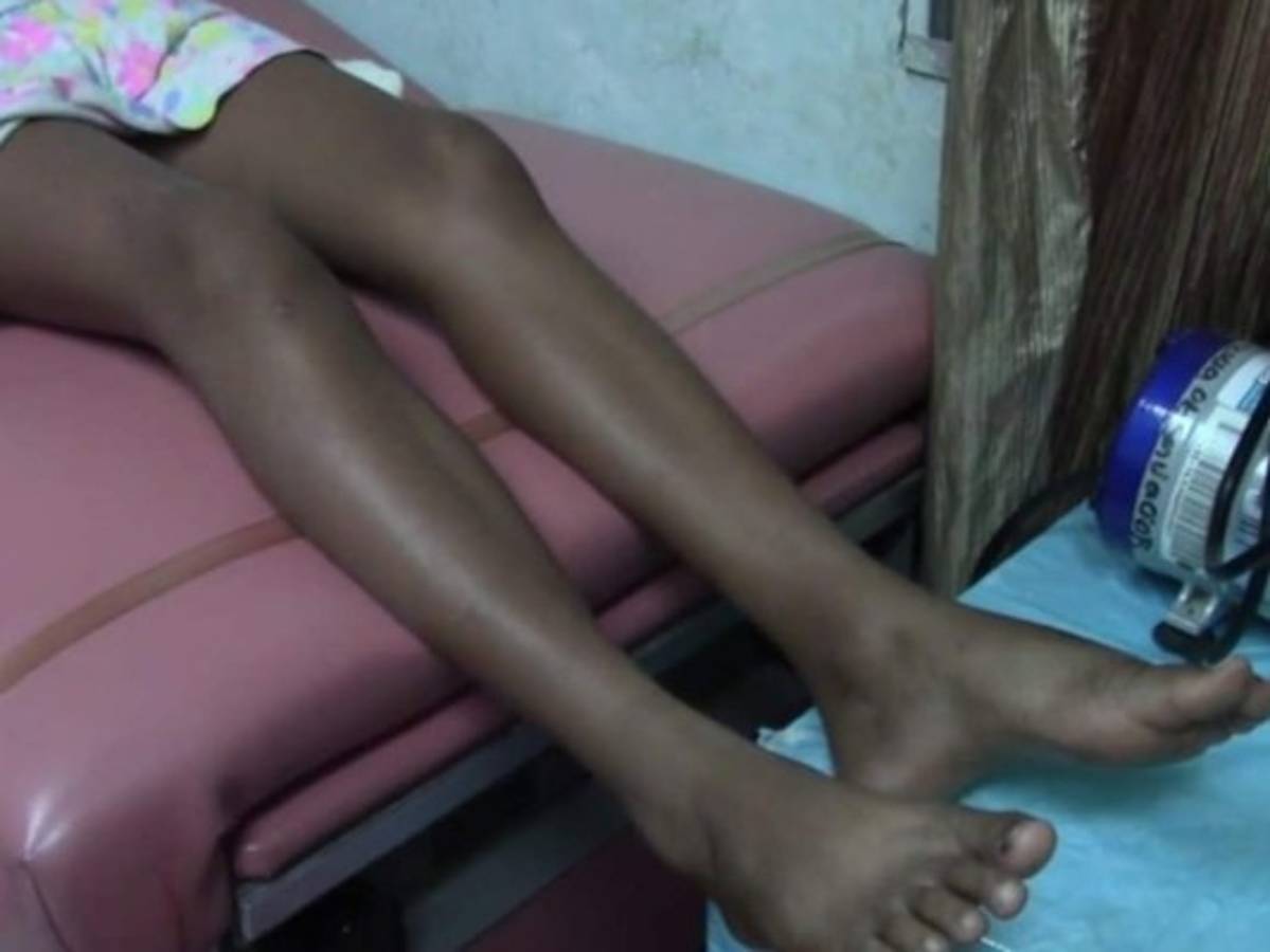 Otra menor es mordida por una serpiente en Choluteca