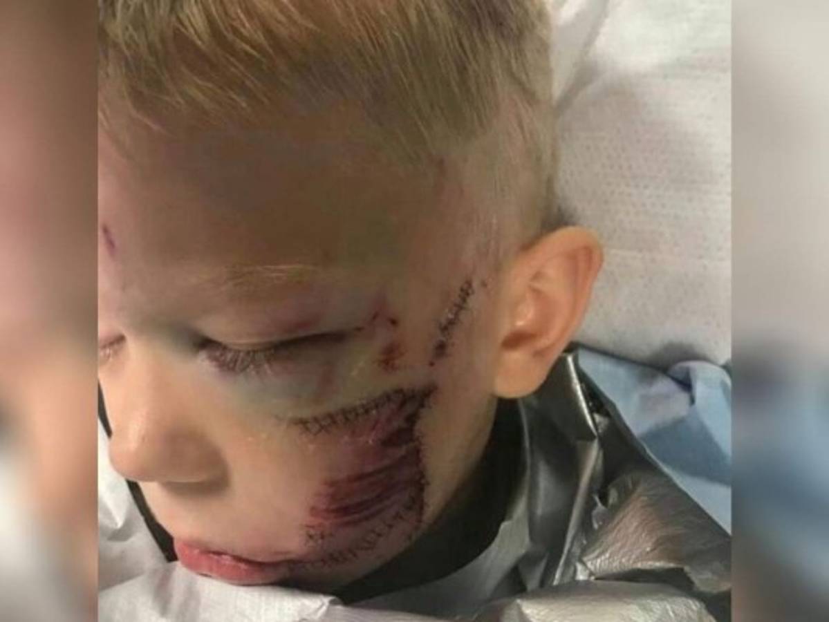 El menor de tan solo seis años tuvo que soportar recibir 90 puntos en su rostro para cerrar las heridas. Foto: @nicolenolewalker