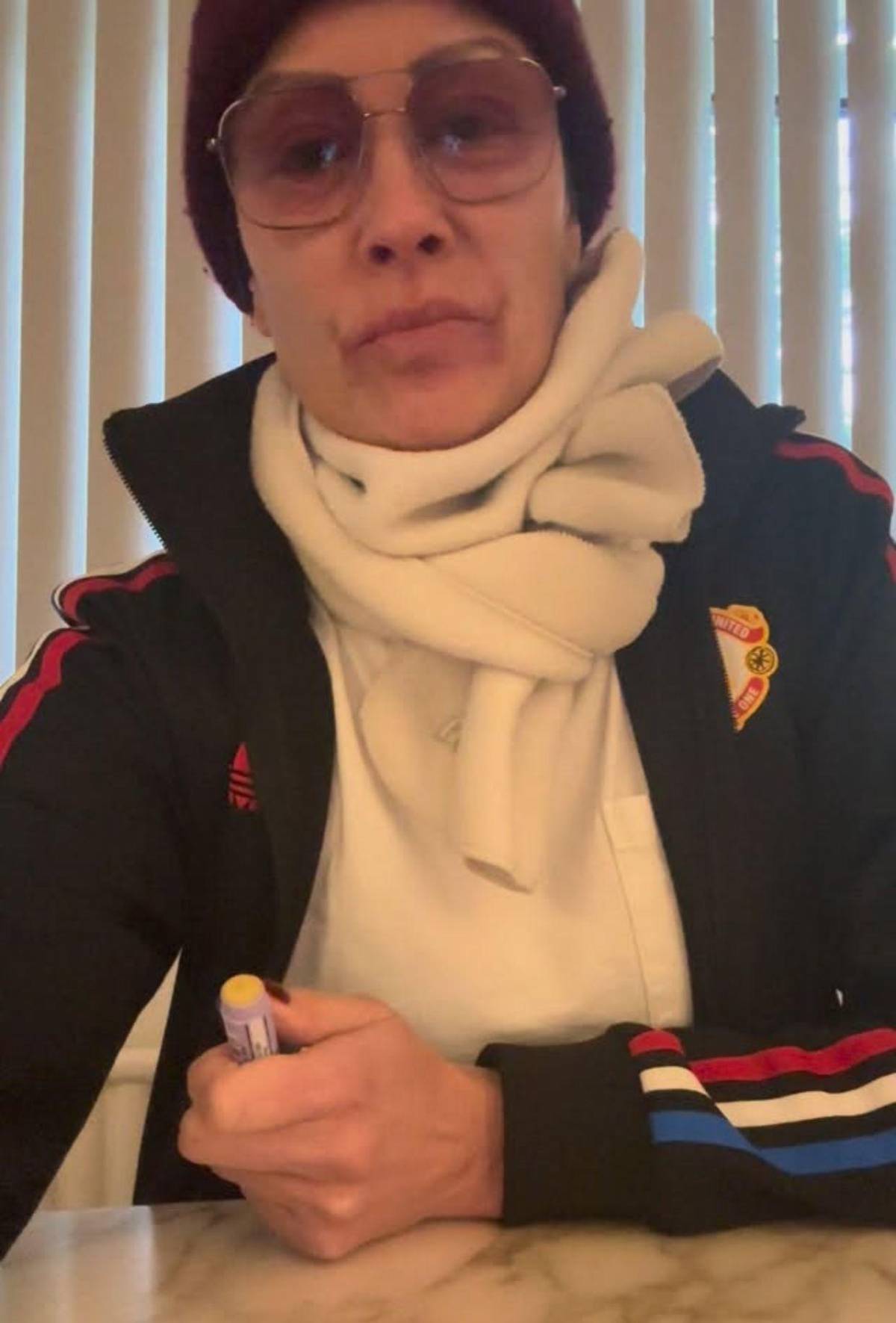 Exmodelo Melanie Sykes, casi calva: enfermedad autoinmune le destruyó el cabello