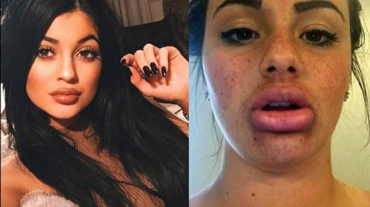 Peligros del 'Bottle lips'