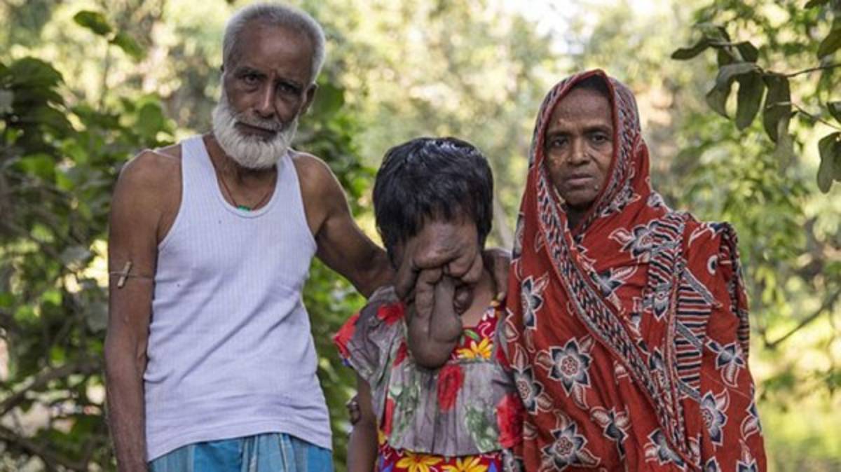 India: La historia de la joven que nació sin cara