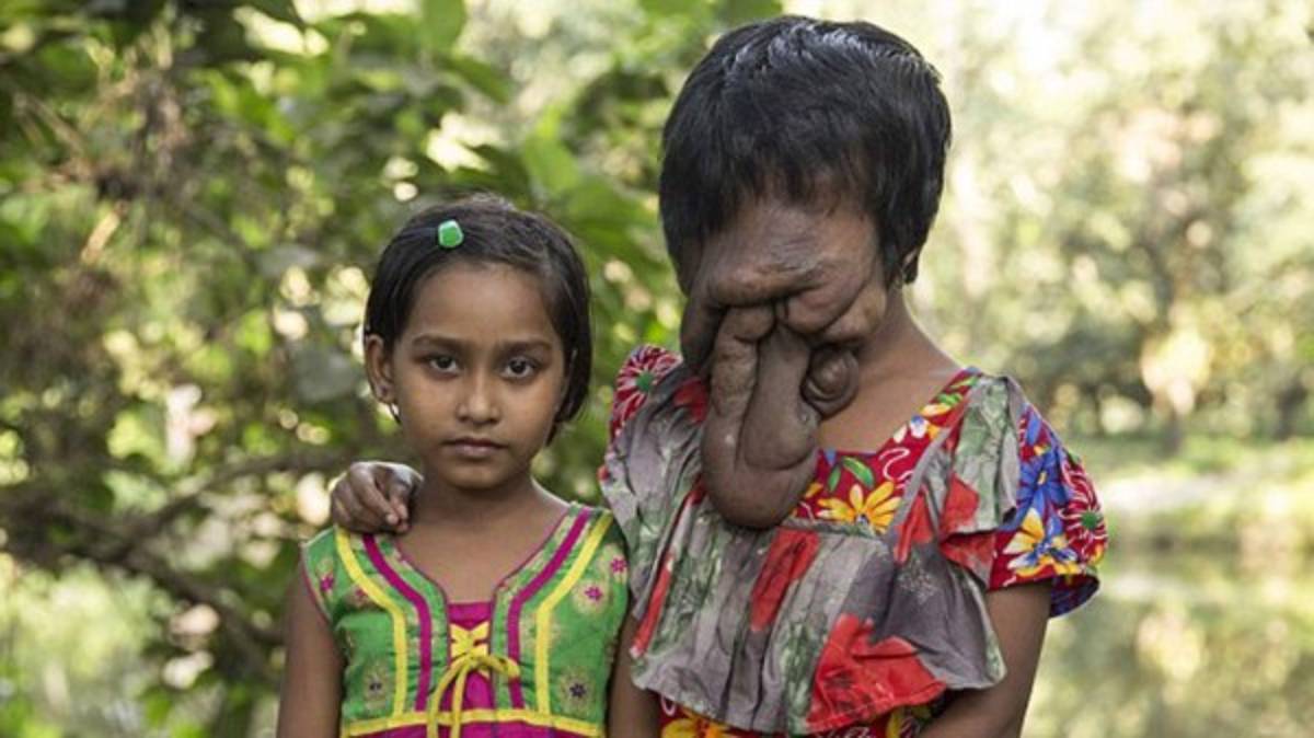 India: La historia de la joven que nació sin cara