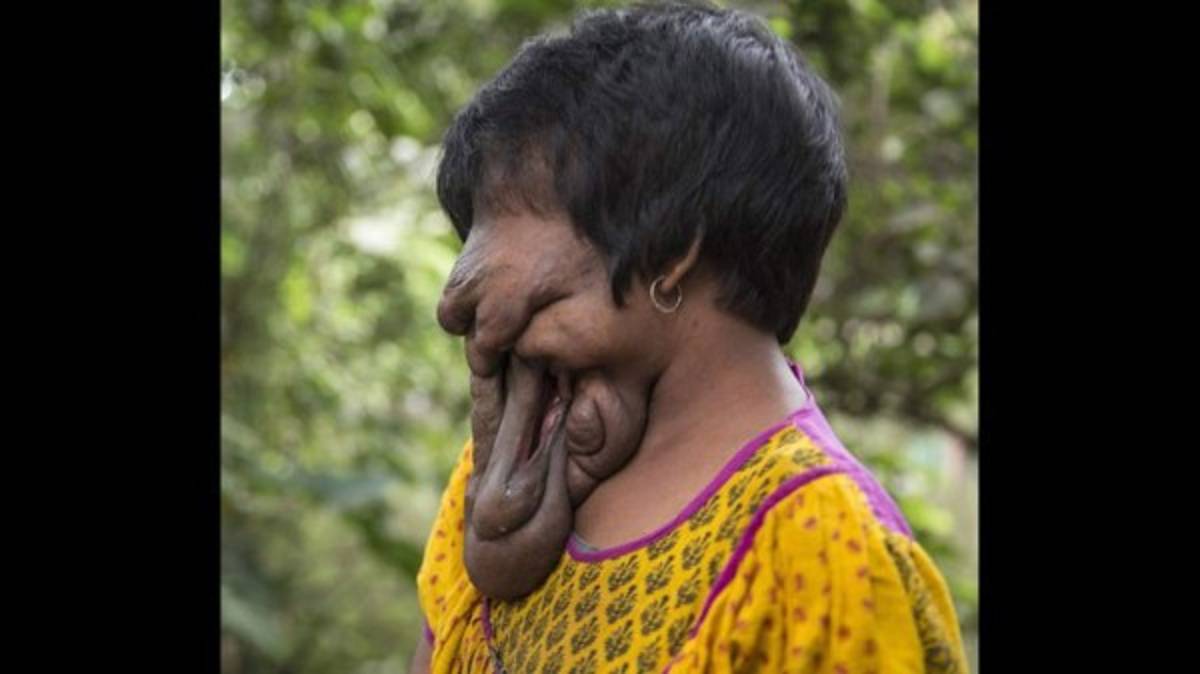 India: La historia de la joven que nació sin cara