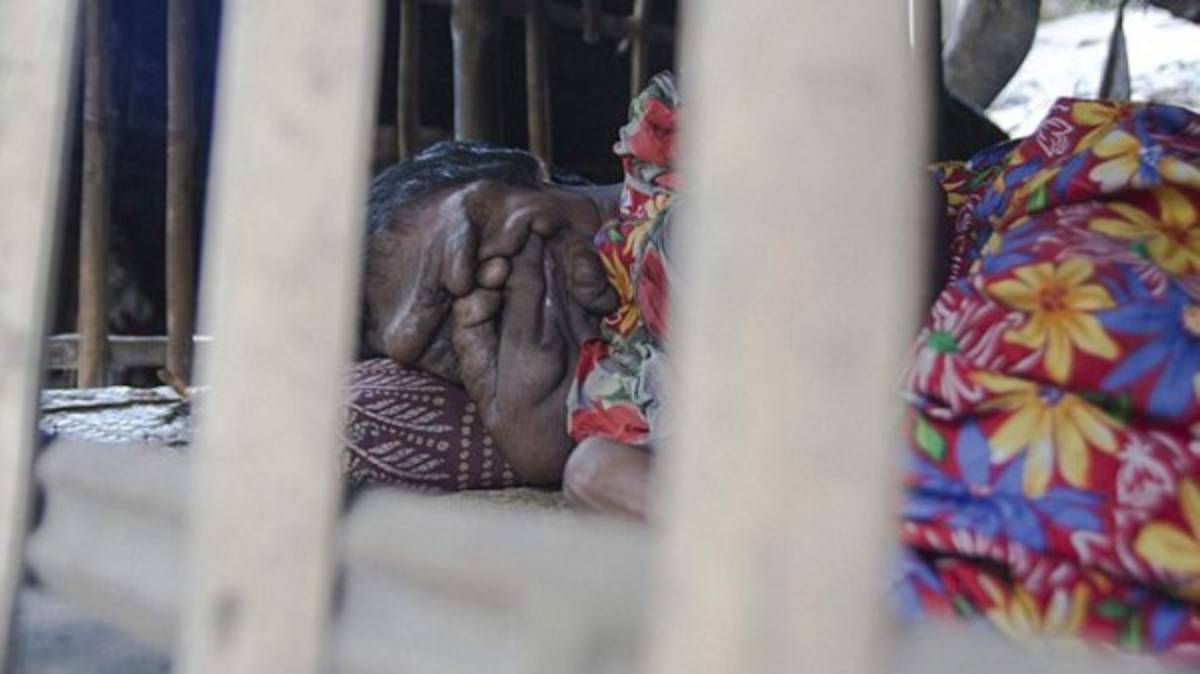 India: La historia de la joven que nació sin cara