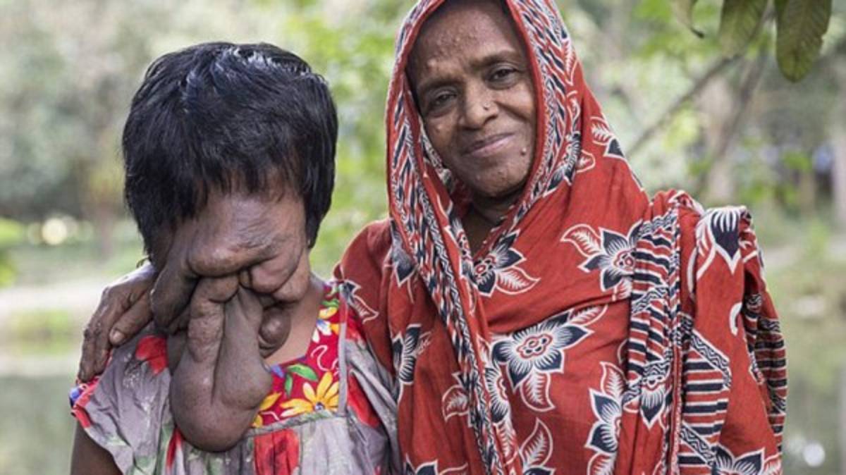 India: La historia de la joven que nació sin cara