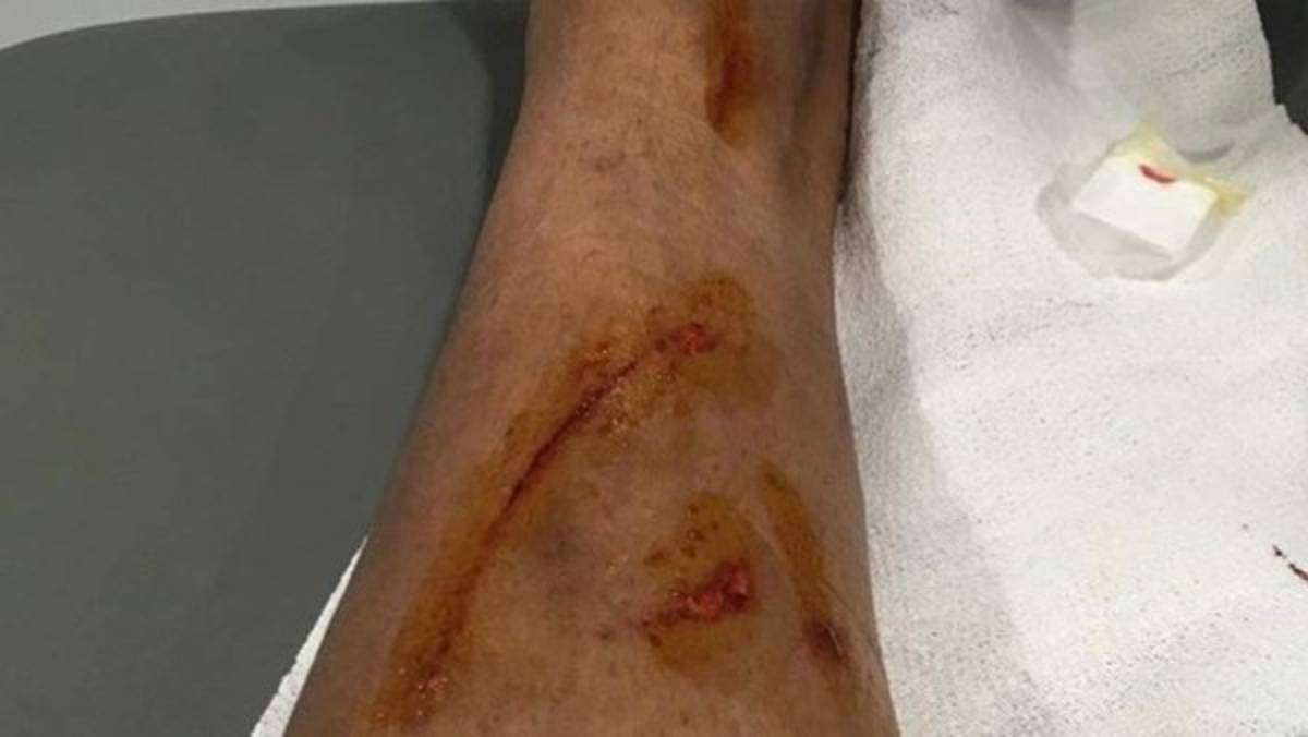 No es grave: Danilo muestra su lesión