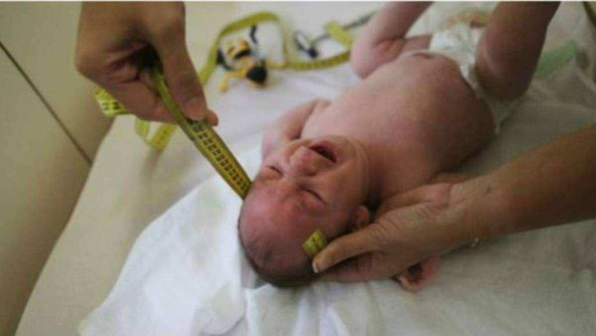 Honduras: Salud declara emergencia por casos de microcefalia en Choluteca