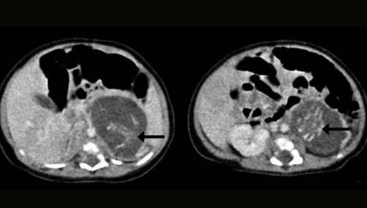 Bebé nace 'embarazada'