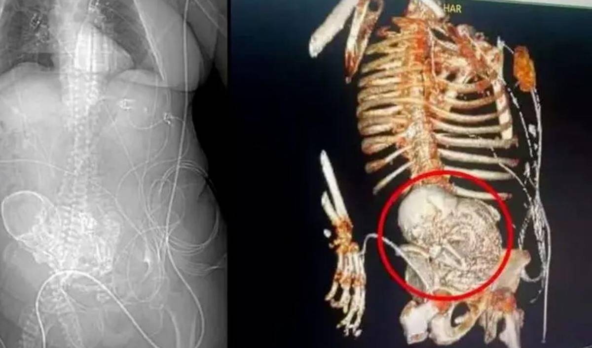Mujer llevó en su vientre un feto calcificado por 40 años