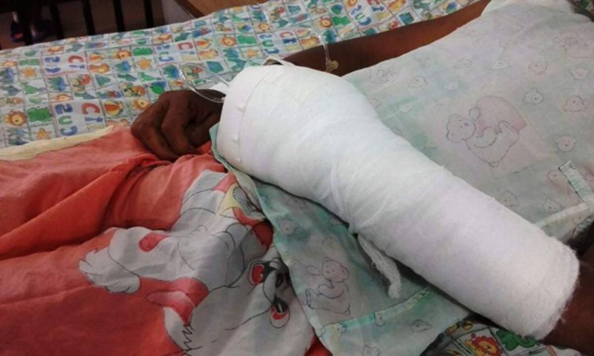 Honduras: 24 pacientes mutilados dejó la Navidad