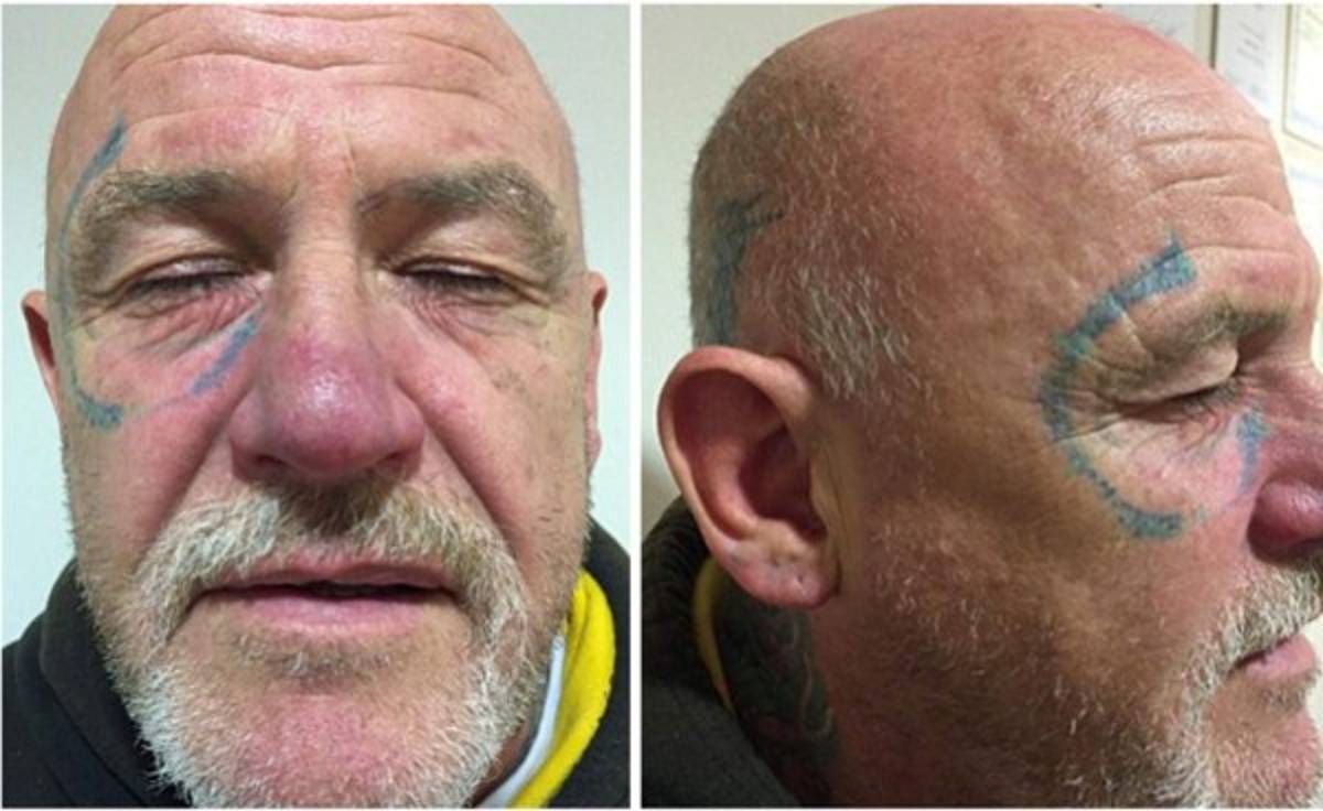 Le tatúan unos 'Ray-Ban' en la cara durante una borrachera