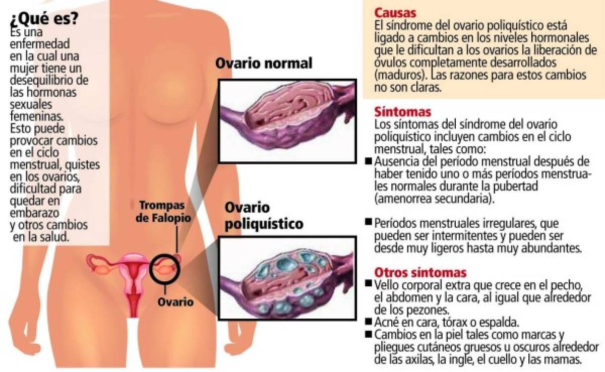 Alta incidencia de ovarios poliquísticos