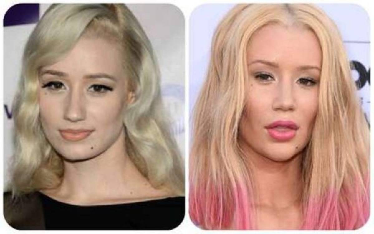 ¿Adicta a las cirugías plásticas? Iggy Azalea reaparece con nuevo rostro