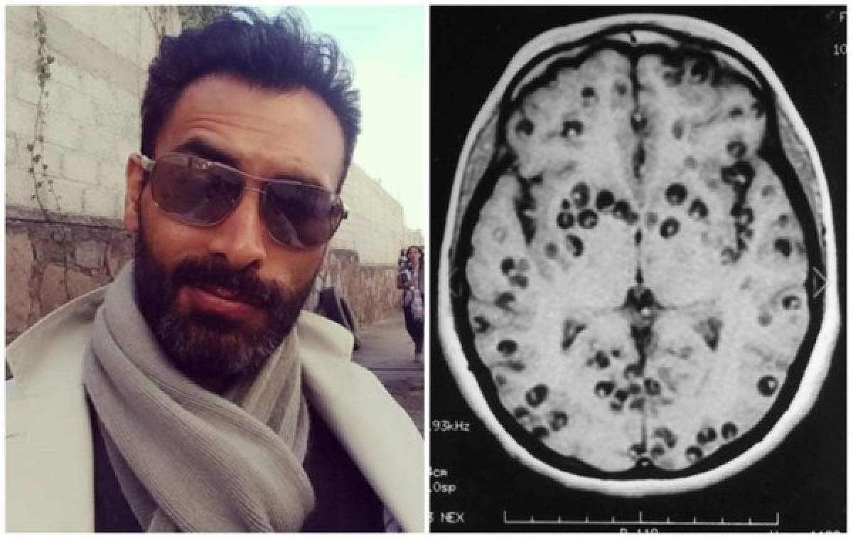 Qué es la cisticercosis, enfermedad que mató al actor Sebastian Ferrat