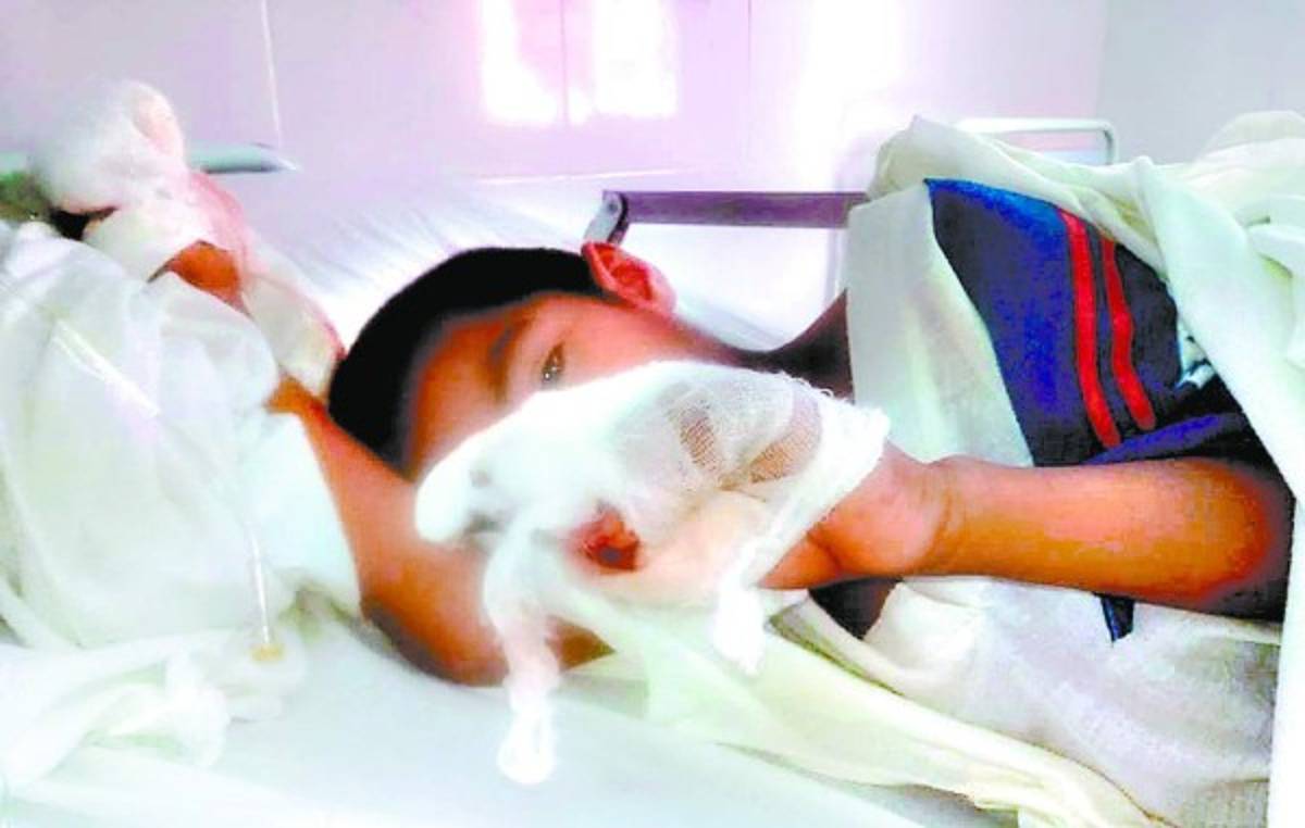 Honduras: A 44 ascienden los quemados por pólvora en Navidad