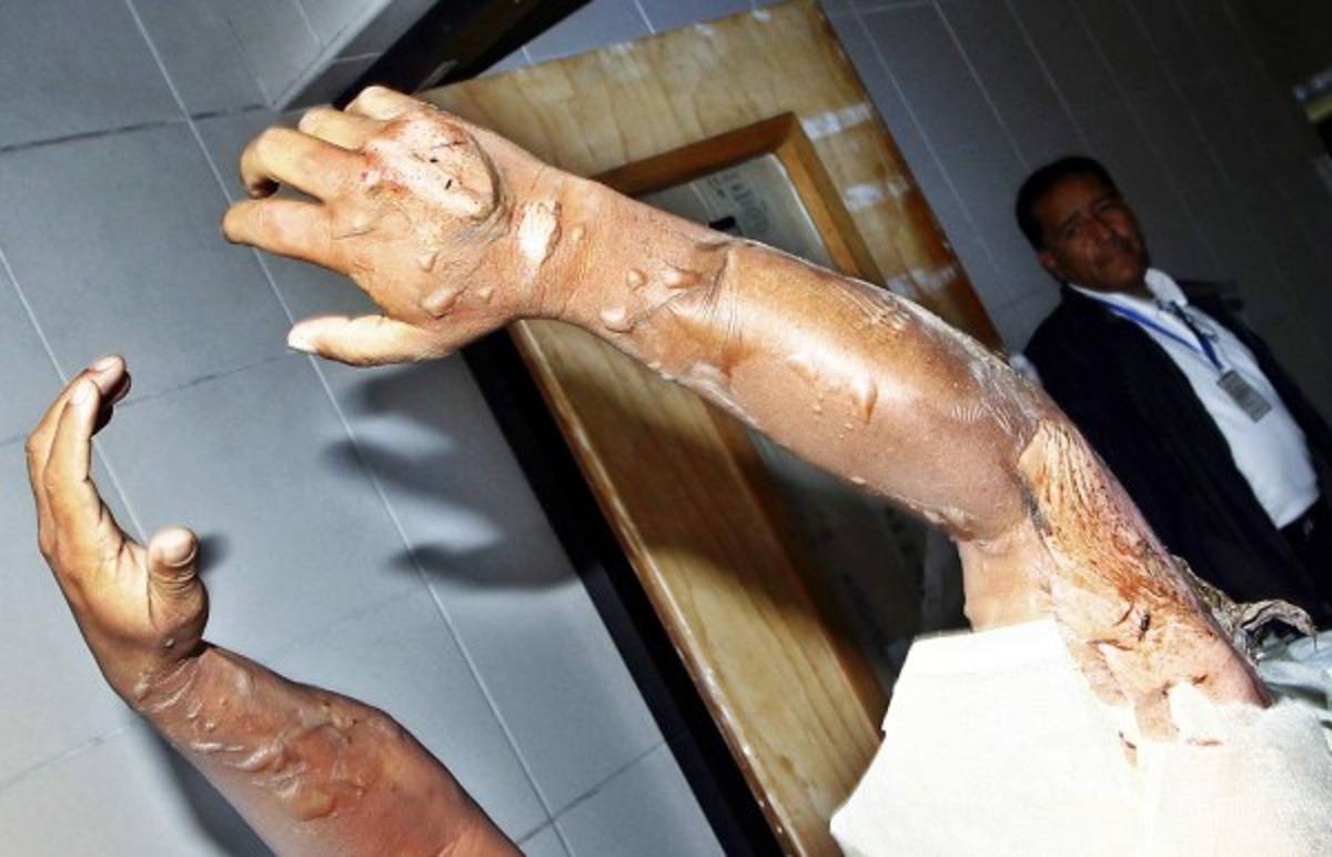 Colapsa sistema sanitario público por incendio