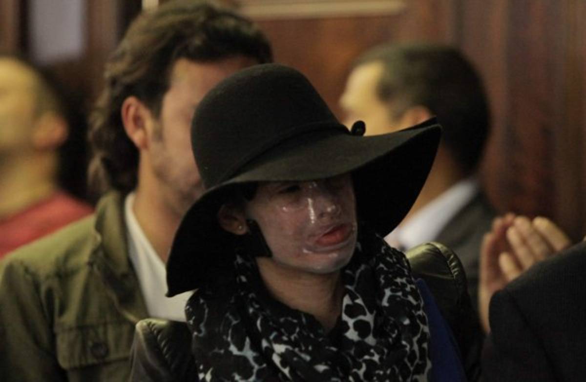 'No siento odio', dice víctima de ataque con ácido en Colombia