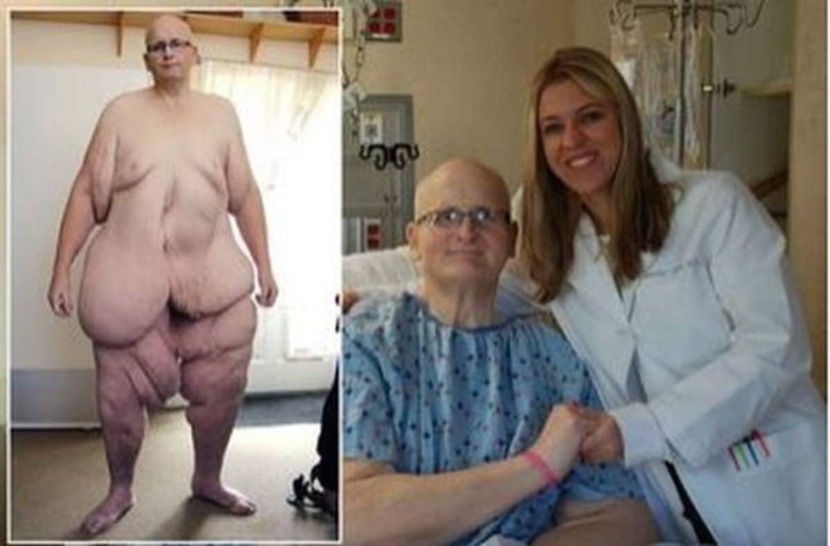 El hombre más gordo del mundo vuelve a caminar