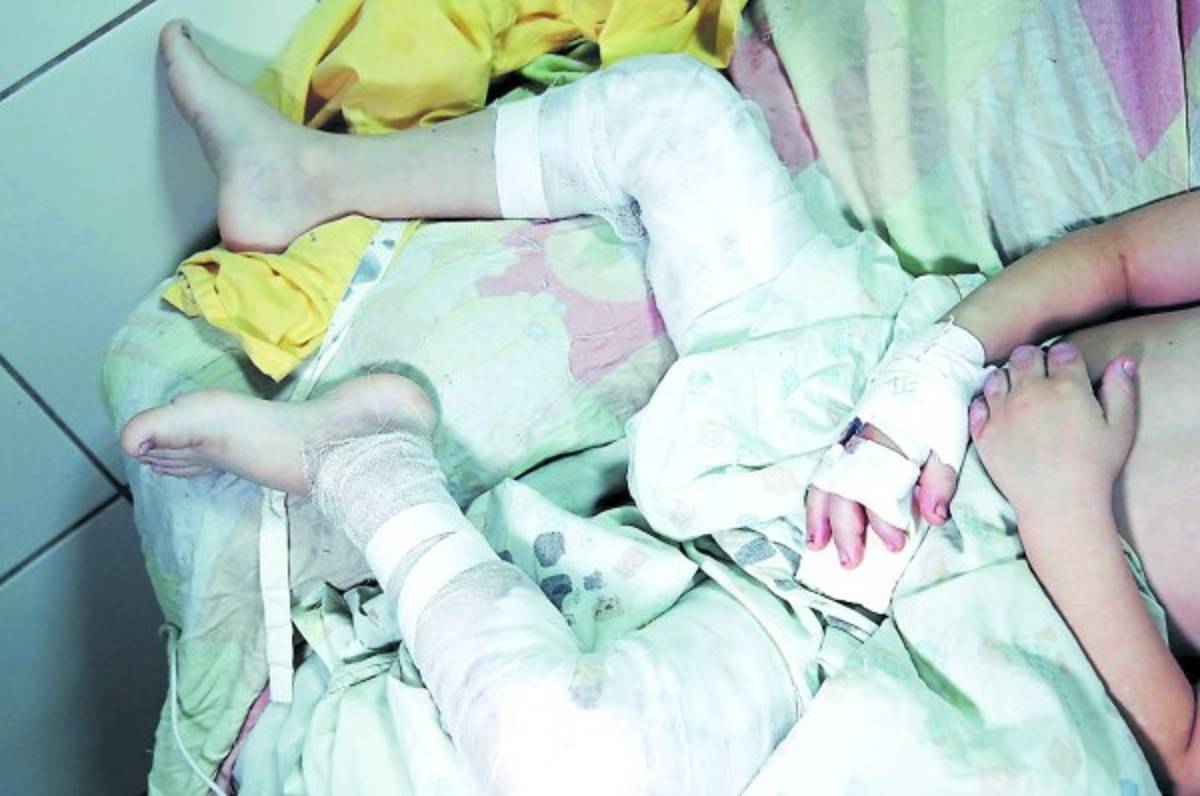 Pacientes quemados por pólvora ya son 131 a nivel nacional