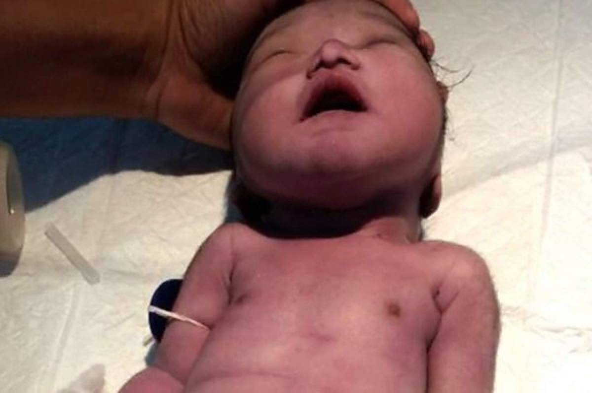 Muere 'bebé sirena” horas después de nacer