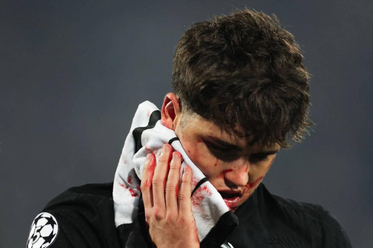 Fuertes imágenes: así quedó la cara de Pau Cubarsí tras recibir patada en Champions League Fuertes imágenes: así quedó la cara de Pau Cubarsí tras recibir patada en Champions League