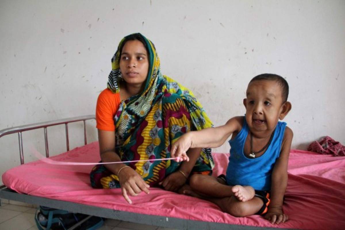 Misteriosa enfermedad hace que niño bangladesí de cuatro años parezca un anciano