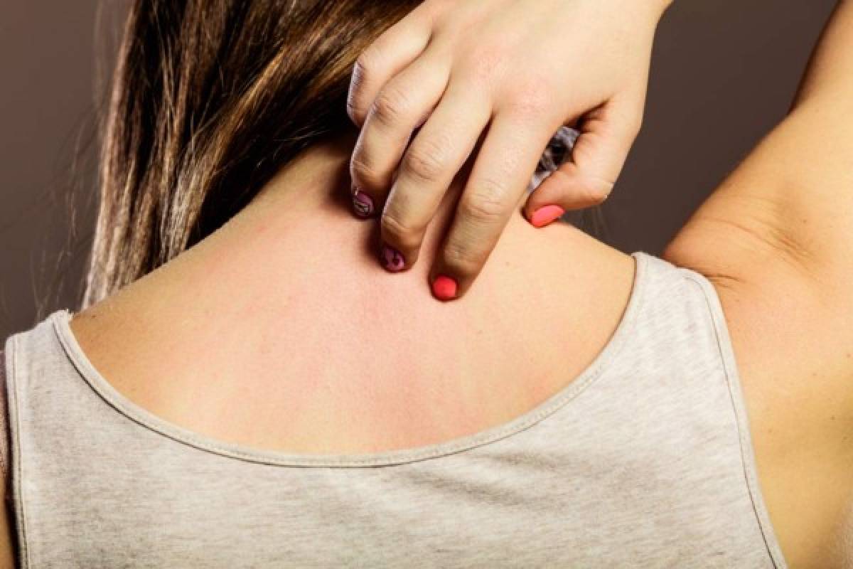 ¿Cuáles son los tipos de dermatitis?