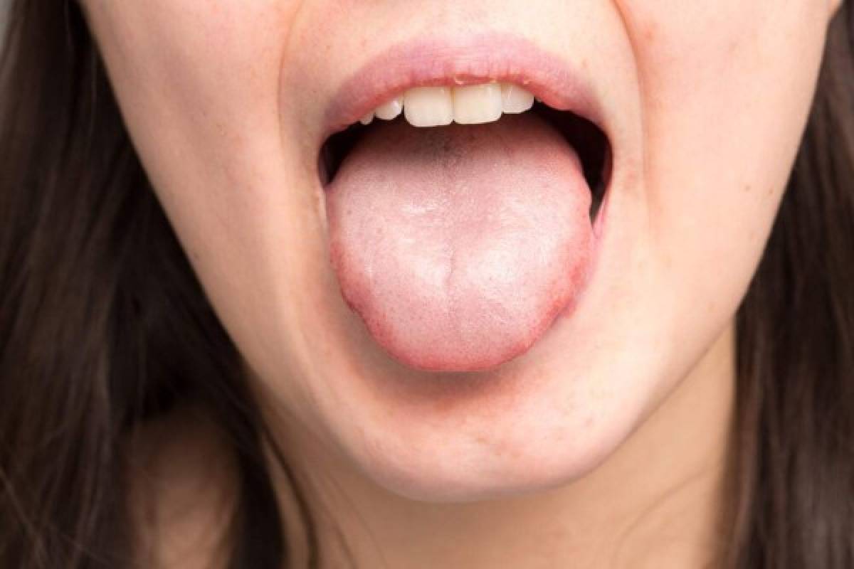 ¿Qué son los tonsilolitos y cómo eliminarlos?