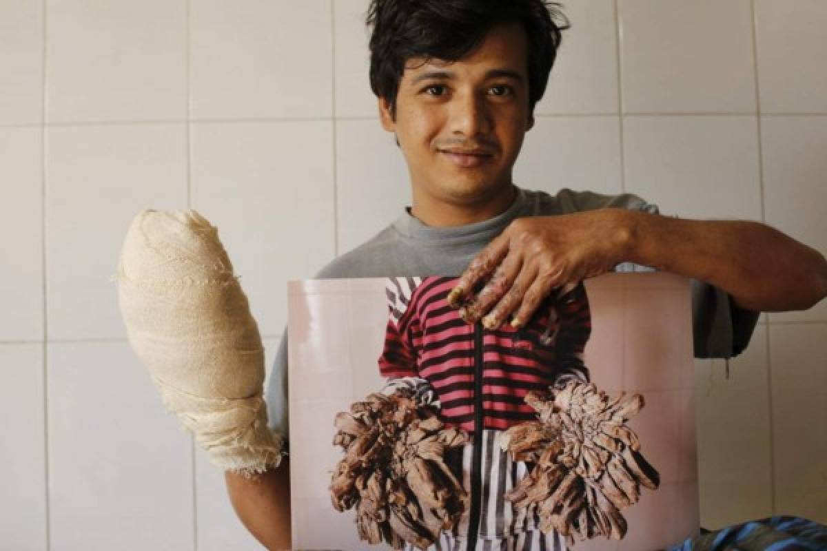 Hombre árbol vuelve a ver sus manos tras someterse a 16 cirugías
