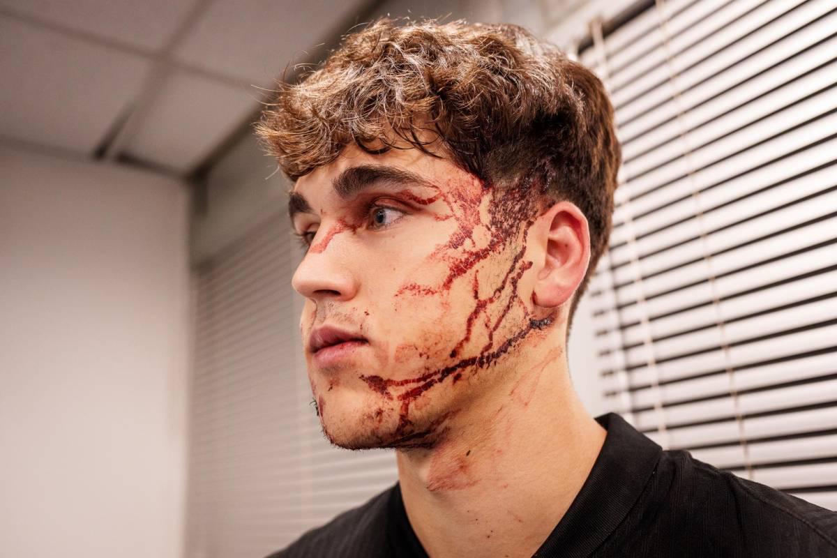 Fuertes imágenes: así quedó la cara de Pau Cubarsí tras recibir patada en Champions League Fuertes imágenes: así quedó la cara de Pau Cubarsí tras recibir patada en Champions League