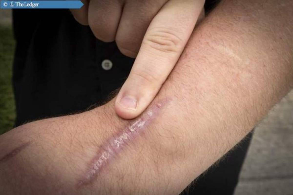 Florida: Hombre sobrevive a rayo, araña y serpiente