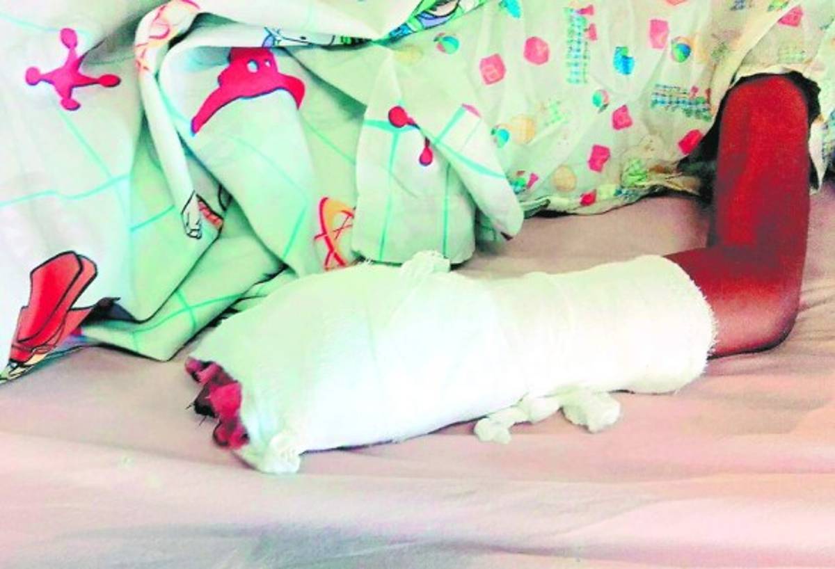 Dos menores más quemados por pólvora en el HEU