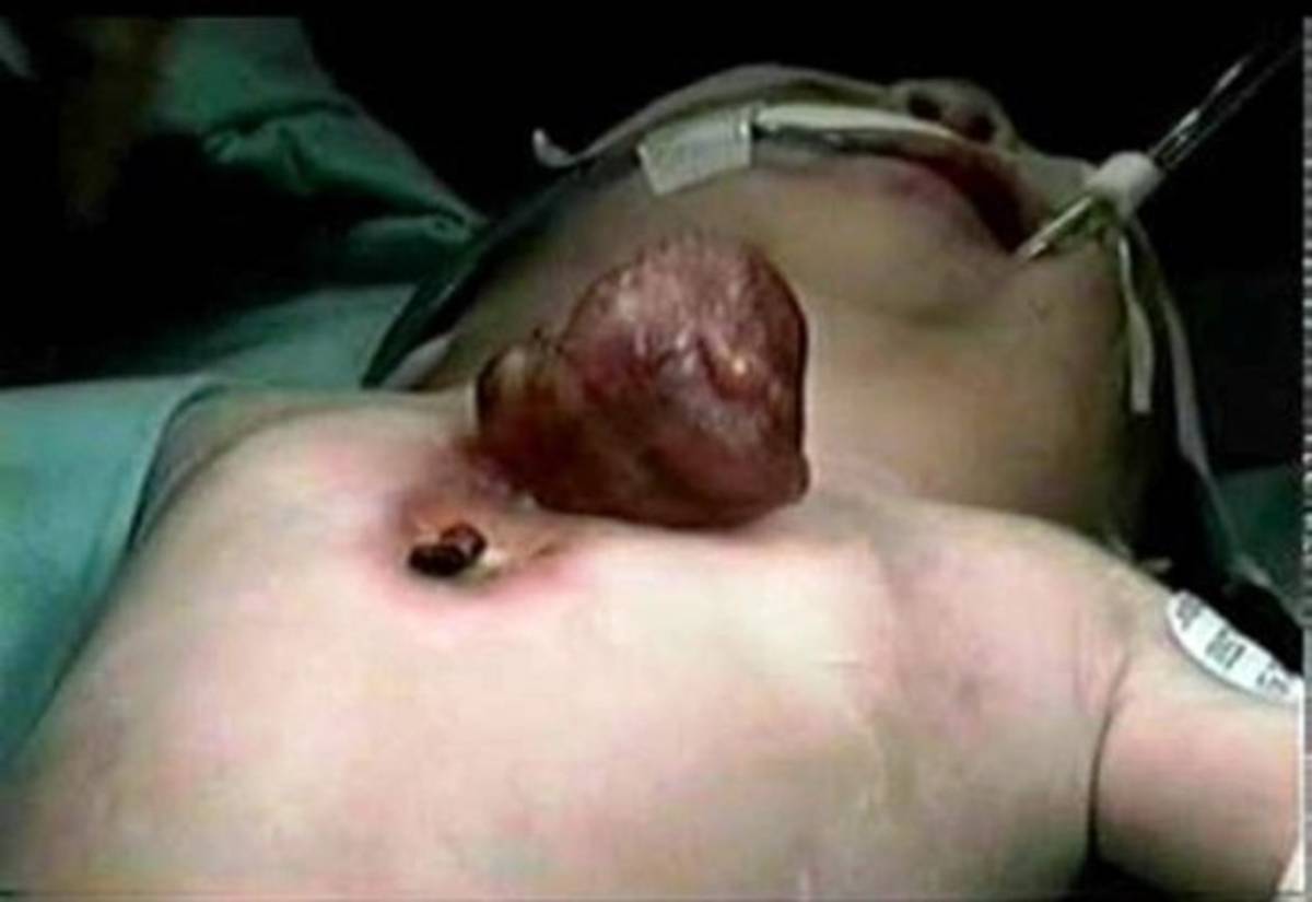 Un niño nació con el corazón fuera del tórax en la India