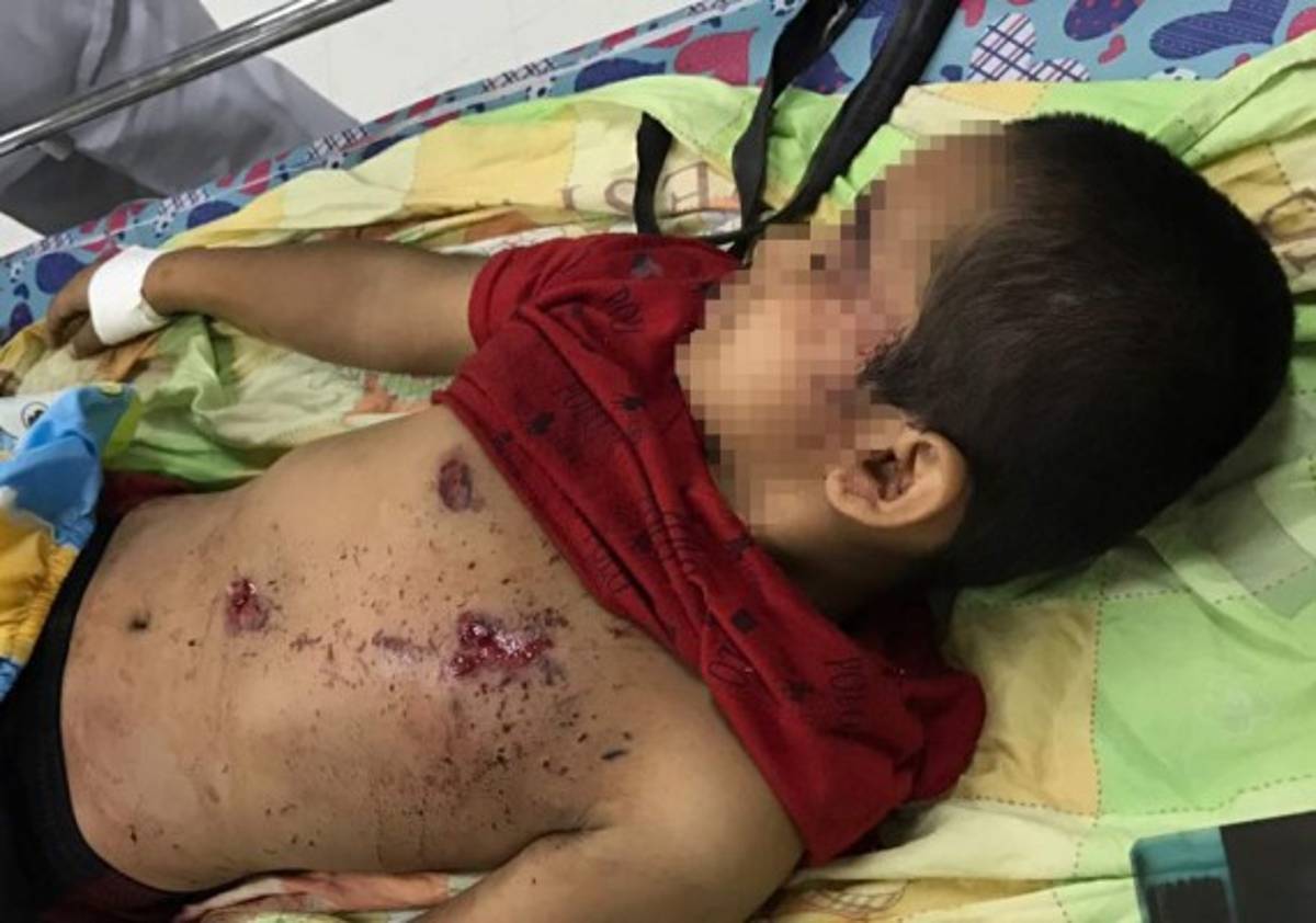 Honduras: Niño de 10 años pierde la mano por explosión de mortero