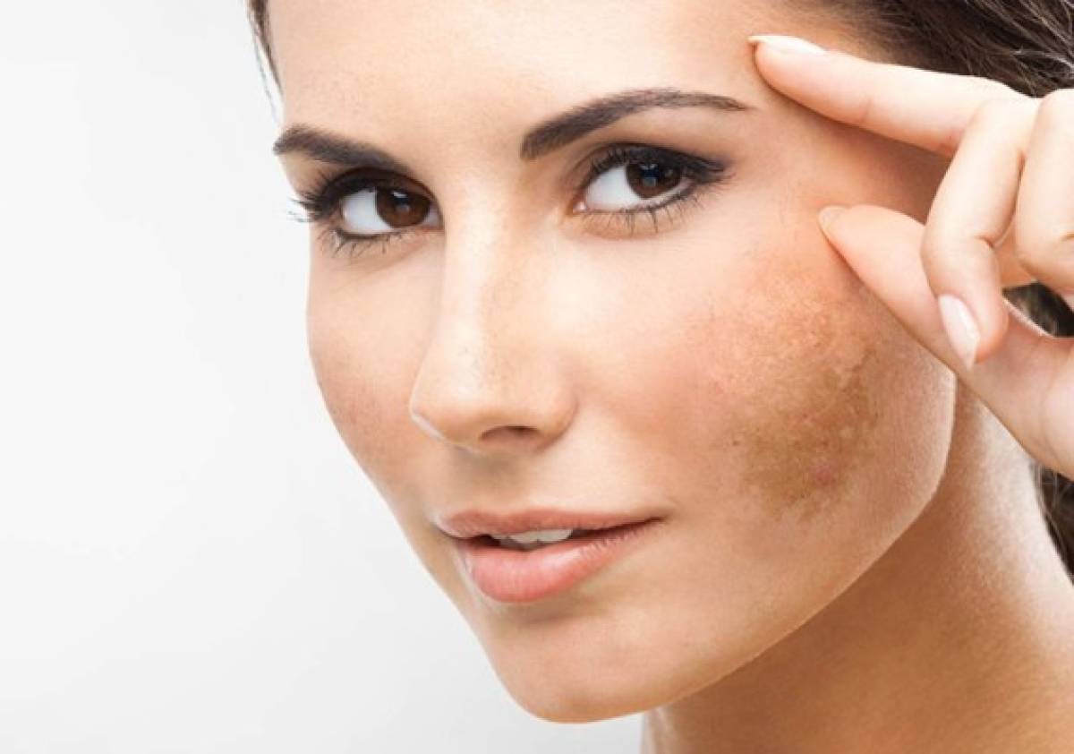 6 remedios naturales para atenuar el paño de la piel