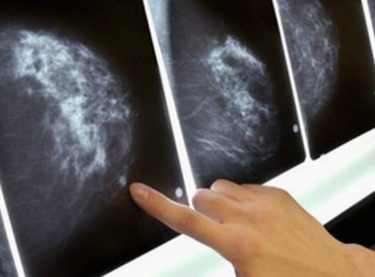Cada año más hombres están sufriendo cáncer de mama en Honduras