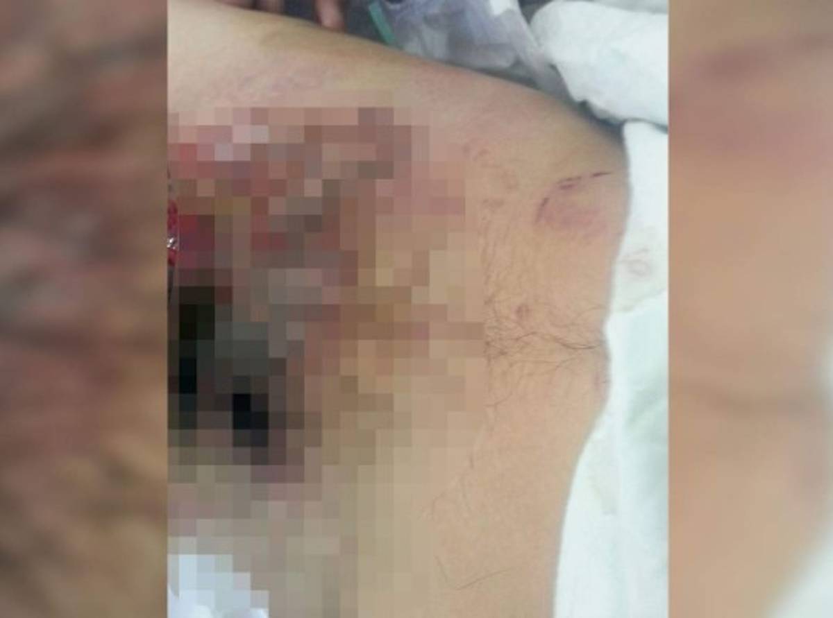 Reportan el primer quemado por pólvora en la capital de Honduras