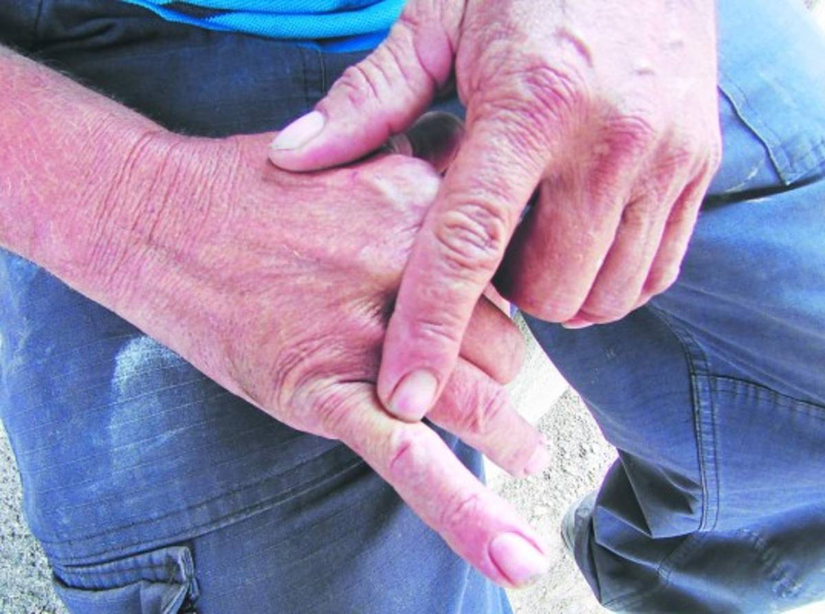 Aumentan casos por mordedura de serpientes en Honduras