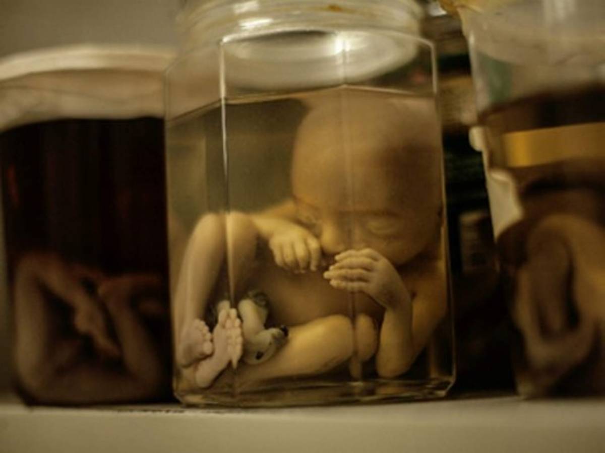 Zika podría causar más deficiencias además de microcefalia