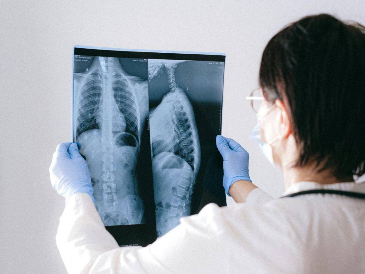El cáncer de pulmón que afecta al papa León XIV: qué es el adenocarcinoma y cómo se trata