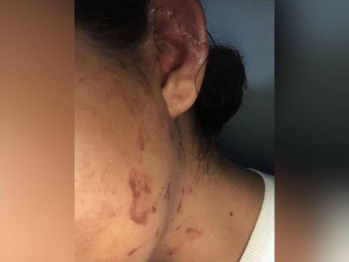 Golpes y mordidas: mujer fue salvajemente atacada por su pareja en Olancho