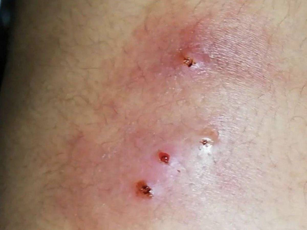 ¿Cuáles son los síntomas de la enfermedad del gusano barrenador en humanos?