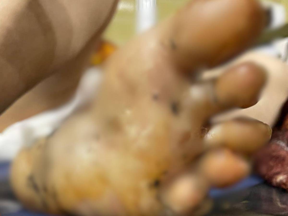 Adultos mayores sufren quemaduras tras incendio que arrasó con seis viviendas en barrio San Martín